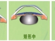 角膜塑形镜