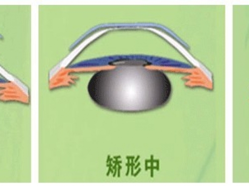 角膜塑形镜