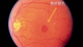 【眼底病小知识】黄斑裂孔是什么？怎么治疗？