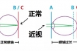 锻炼治愈近视？？江湖疗法切勿轻信