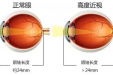 害怕高度近视遗传给下一代？别慌还有救