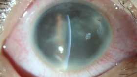 病例报道——儿童眼爆炸伤伴眼内炎1例