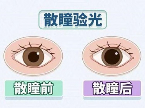 散瞳——近视防控中不可或缺的一环
