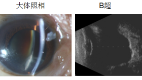 新型劈核器miLOOP助力“黑内障”患者寻回久违的光明……