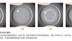 避坑指南！塑形镜护理千万绕开这些误区