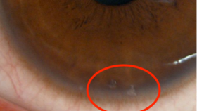 近视手术术后眼上“拉丝